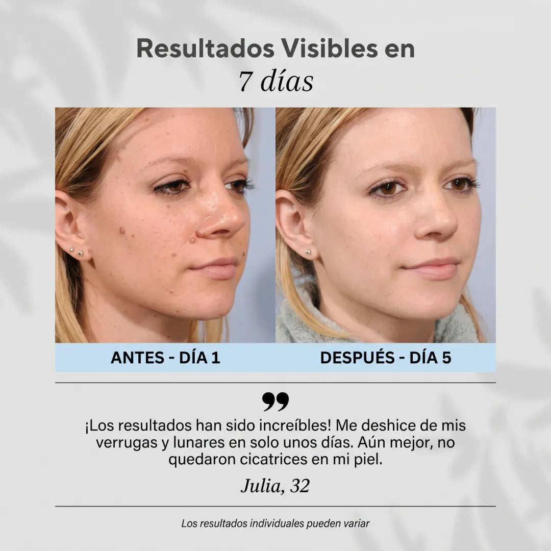 Dermalisse® Lápiz de Plasma Cauterizador 6 en 1 Para Eliminar Imperfecciones de la Piel
