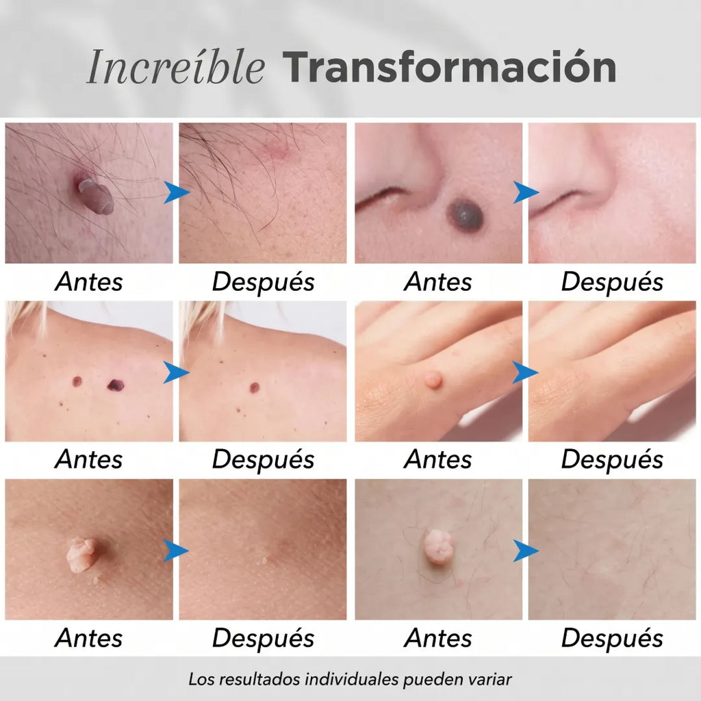 Dermalisse® Lápiz de Plasma Cauterizador 6 en 1 Para Eliminar Imperfecciones de la Piel